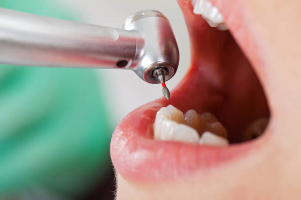 Best Emergency Broken Tooth Repair in Pleasant Hill, TX